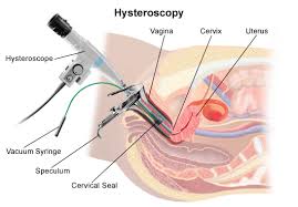 baby - hysteroscopy